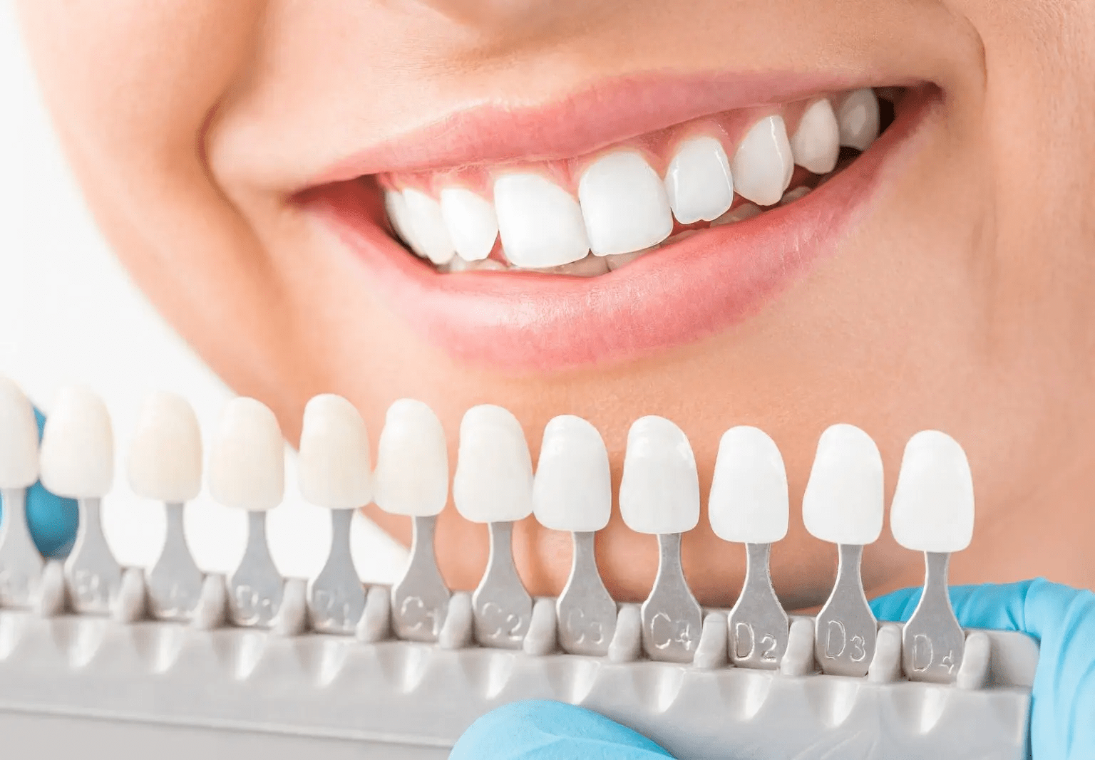 veneers