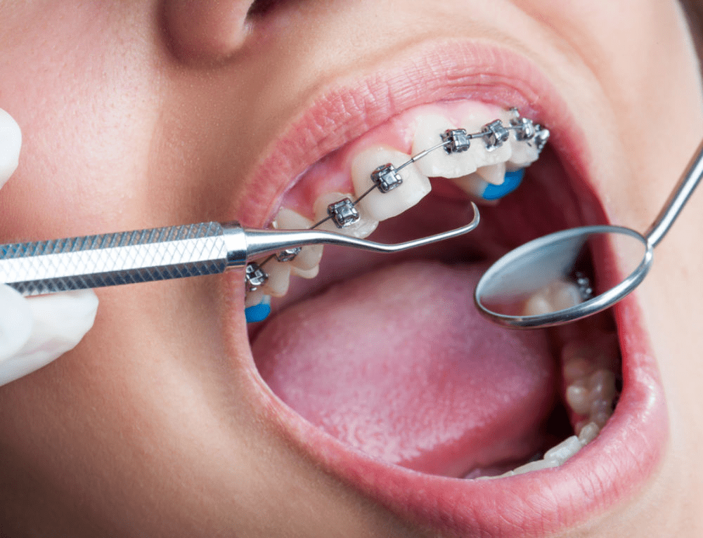 orthodontic braces