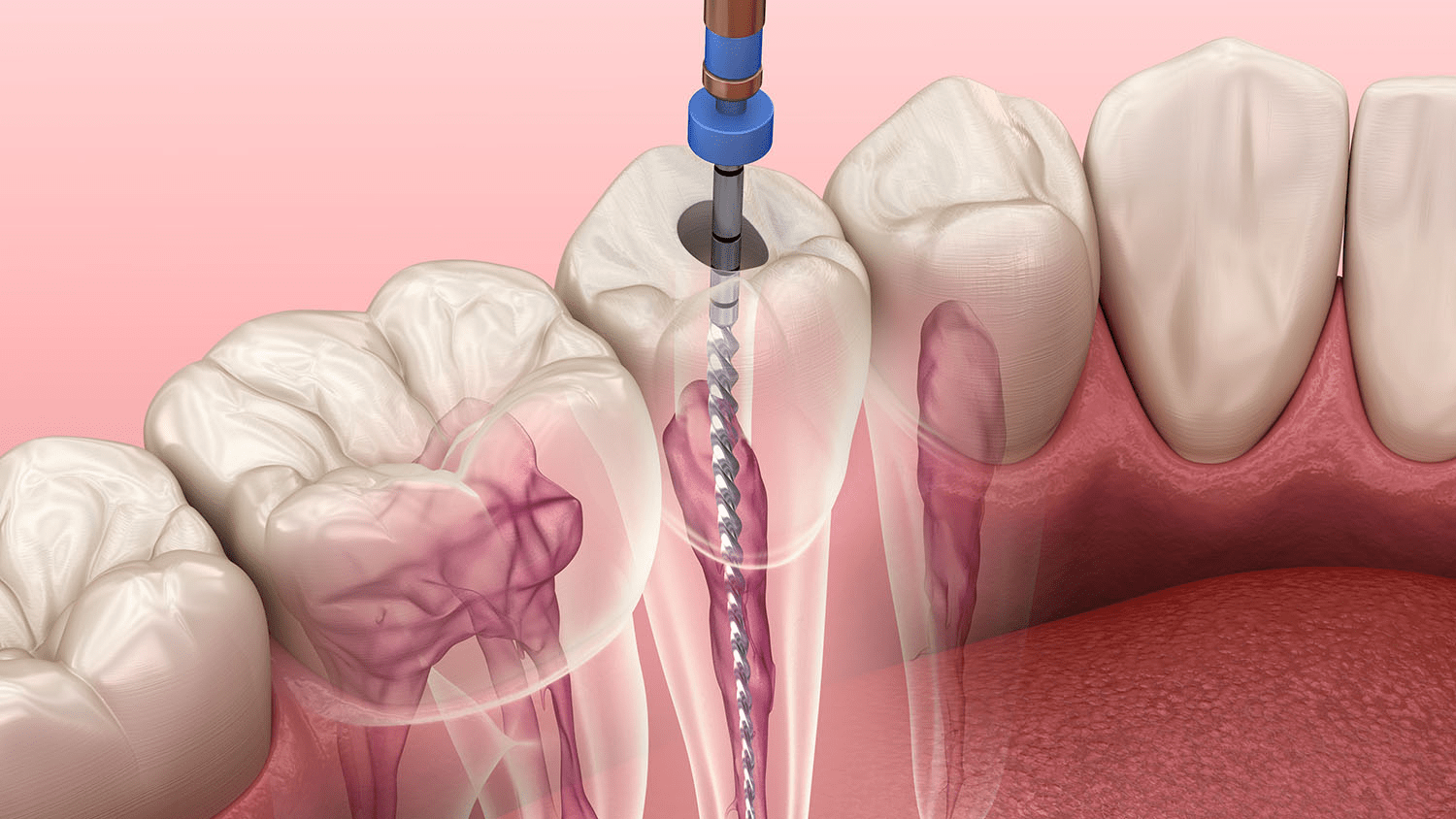root canal therapy