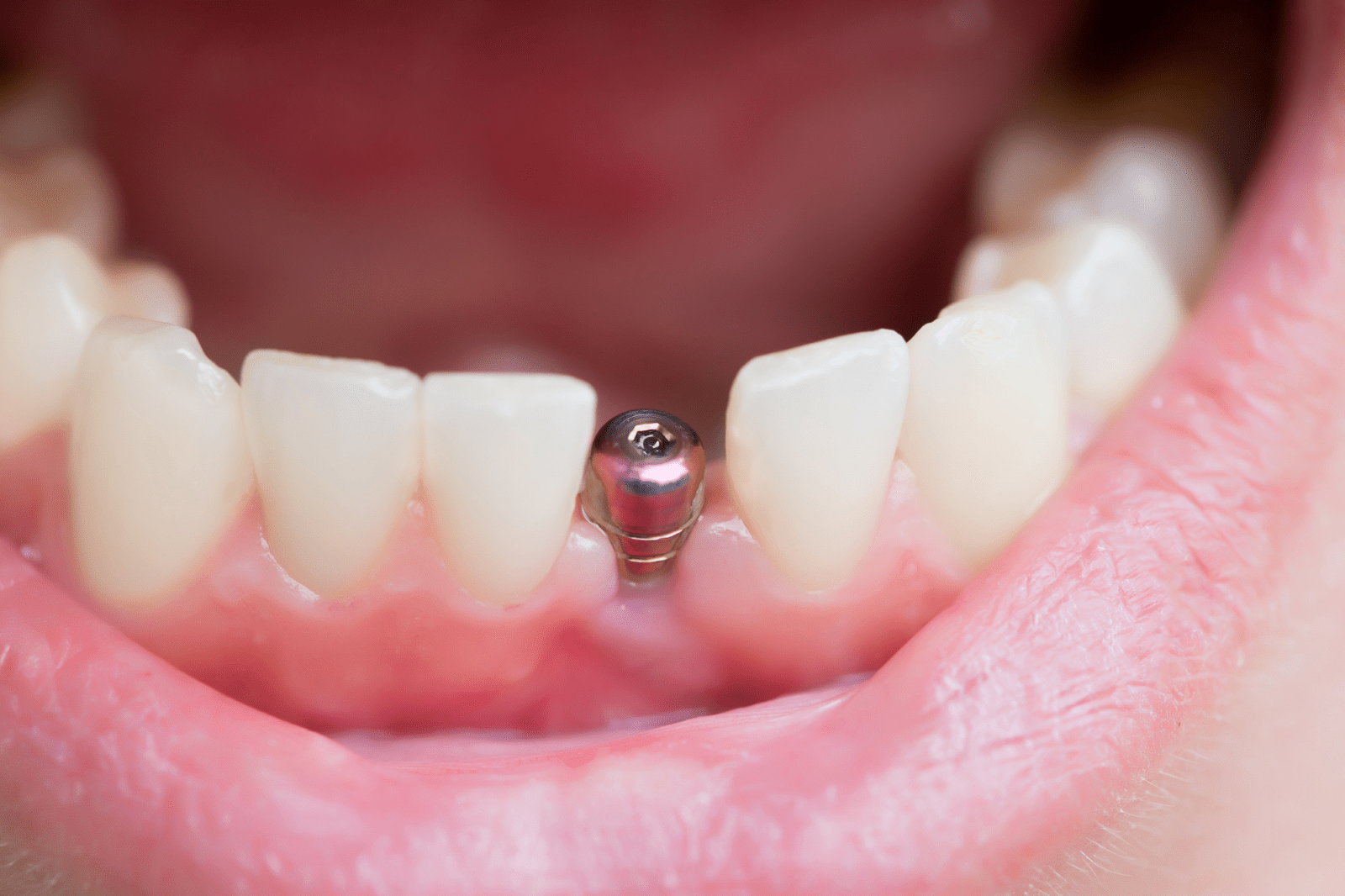 implants & mini dental implants